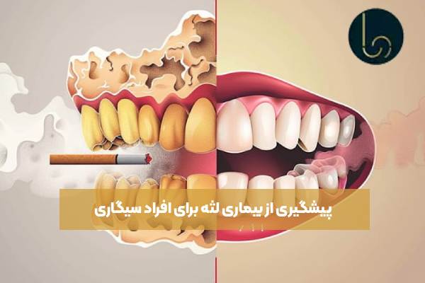 پیشگیری از بیماری لثه برای افراد سیگاری