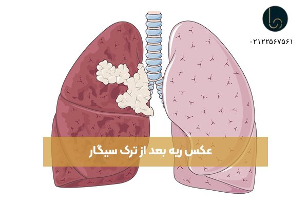 عکس ریه بعد از ترک سیگار