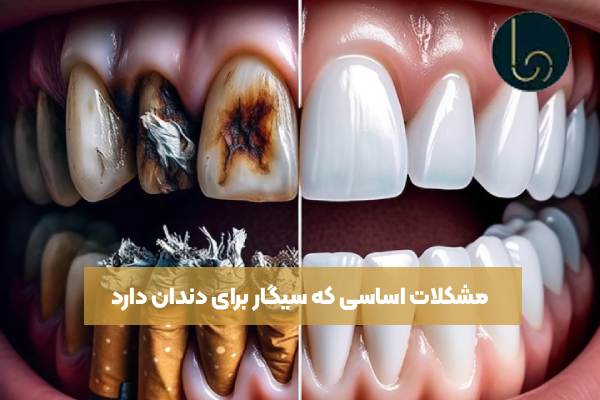 سیگار و اثرات مخرب آن بر سلامت دندان ها!